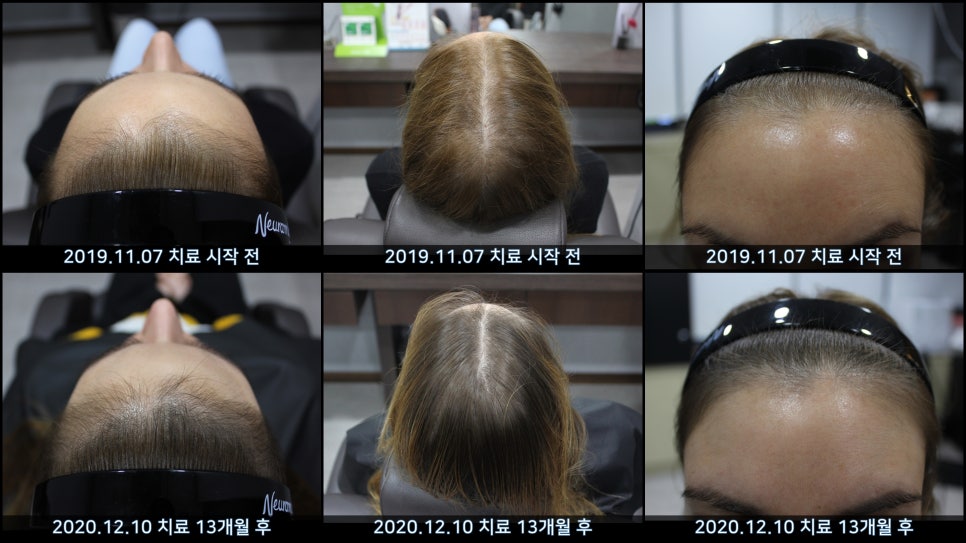 연세봄빛피부과 탈모치료 #40 (여성형탈모, 외국인의 경우) 관련 이미지 8
