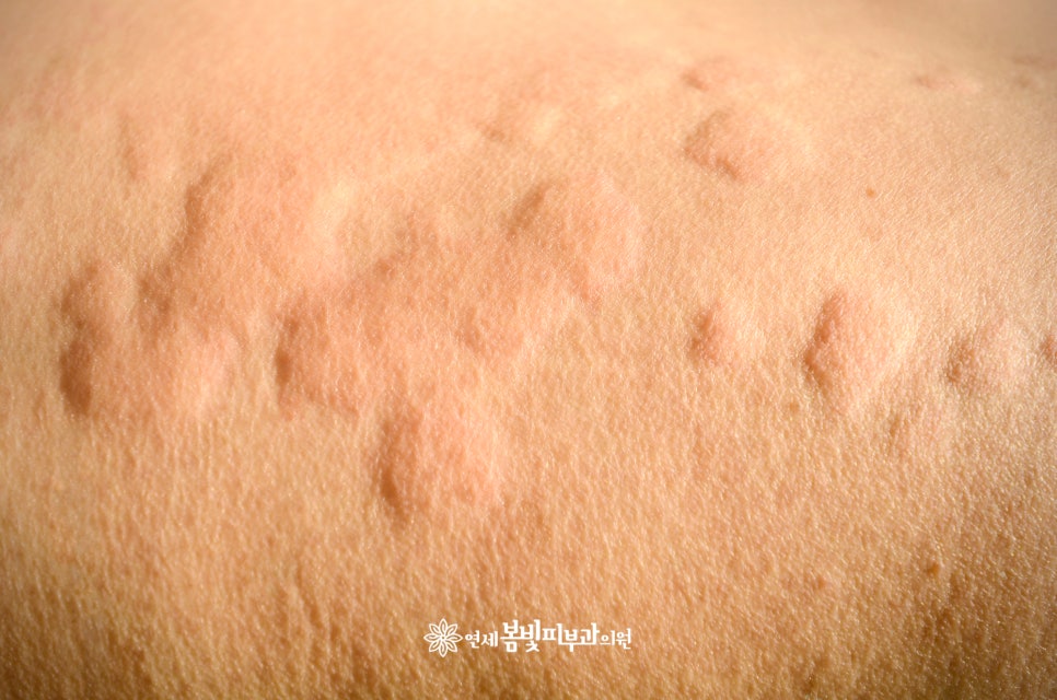 졸레어 주사, 난치성 두드러기 치료 관련 이미지 1