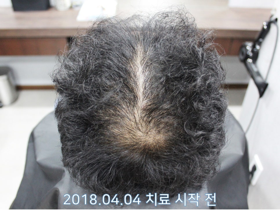 연세봄빛피부과 탈모치료 #20 (남성형탈모, 정수리탈모, 헤어스타일) 관련 이미지 1