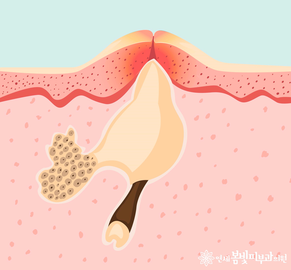 여드름과 이별하는 방법 관련 이미지 2