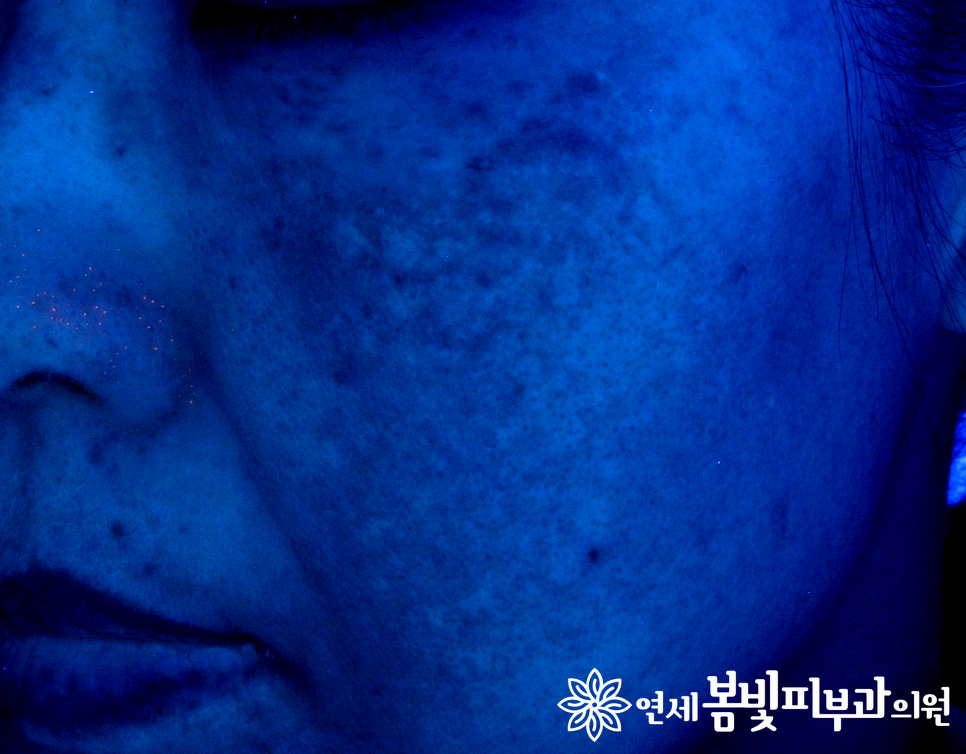 기미치료 부작용을 줄이는 PTP 토닝 관련 이미지 1