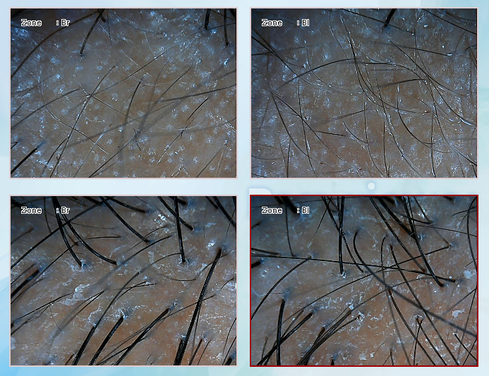 연세봄빛피부과 탈모치료 #2 (남성형탈모, 이마탈모, 정수리탈모) 관련 이미지 7