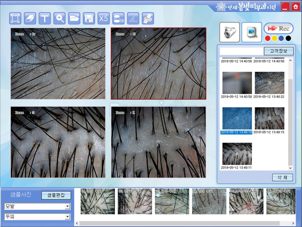 휴지기 탈모, 걱정하지 마세요! 관련 이미지 3