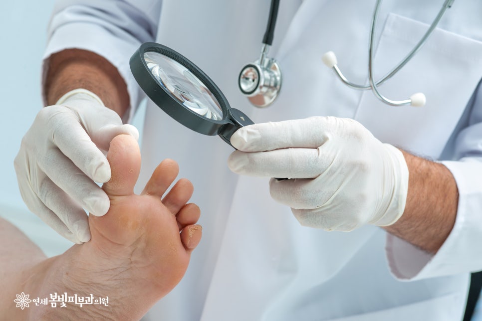 새로운 발톱무좀치료의 시작, 연세봄빛피부과의 오니코레이저 관련 이미지 3