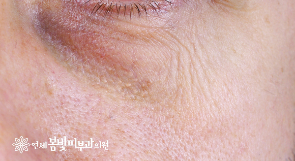 다크써클 없애는법 #3 (다크써클 치료: 레이저 치료, 색소 레이저, 레이저 토닝, 혈관 레이저, 탄력 레이저, 하이푸) 관련 이미지 4