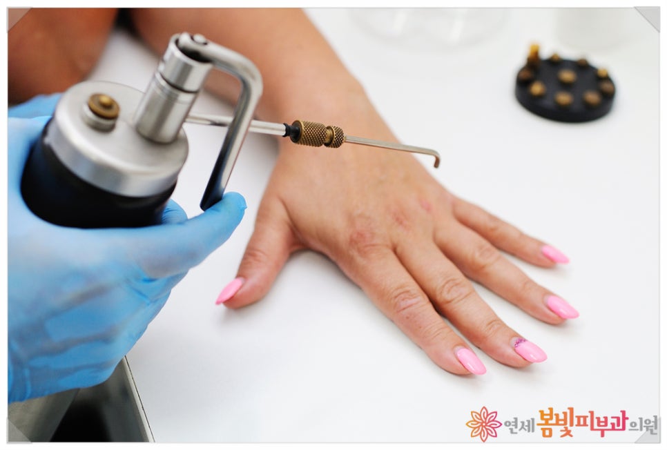 바이러스성 사마귀, 어떻게 치료 하나요? (사마귀 치료 방법, 냉동 치료, 블레오마이신 주사 치료,  레이저 치료, 면역 치료) 관련 이미지 1