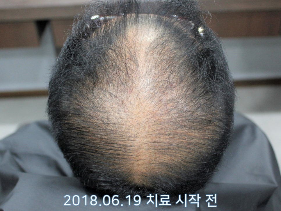 연세봄빛피부과 탈모치료 #16 (남성형탈모, 이마탈모, 정수리탈모, 3단계) 관련 이미지 1