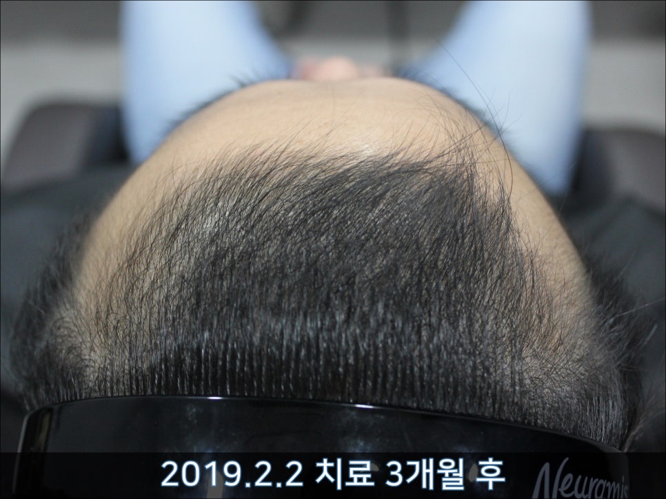 연세봄빛피부과 탈모치료 #33 (남성형탈모, 이마탈모, 정수리탈모, 가족력없음) 관련 이미지 3