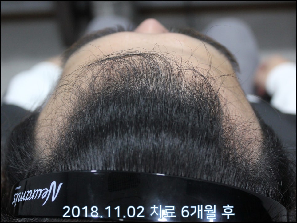 연세봄빛피부과 탈모치료 #23 (남성형탈모, 이마탈모, 정수리탈모) 관련 이미지 6