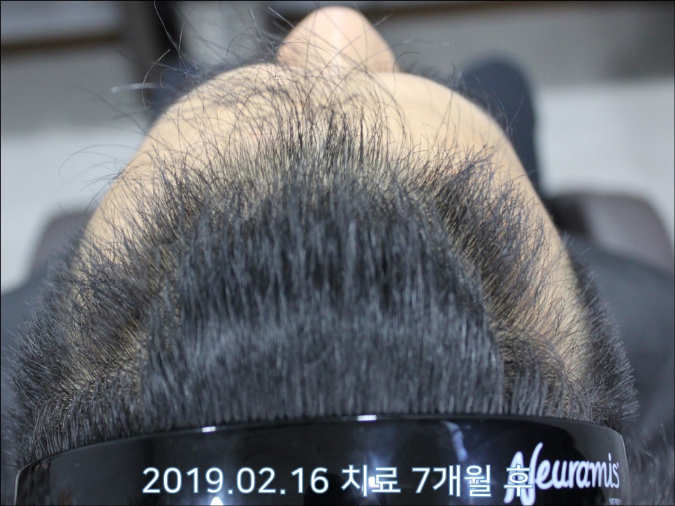연세봄빛피부과 탈모치료 #27 (남성형탈모, 이마탈모 정수리탈모) 관련 이미지 6