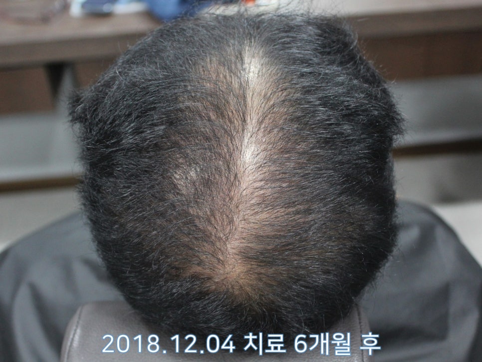 연세봄빛피부과 탈모치료 #16 (남성형탈모, 이마탈모, 정수리탈모, 3단계) 관련 이미지 3