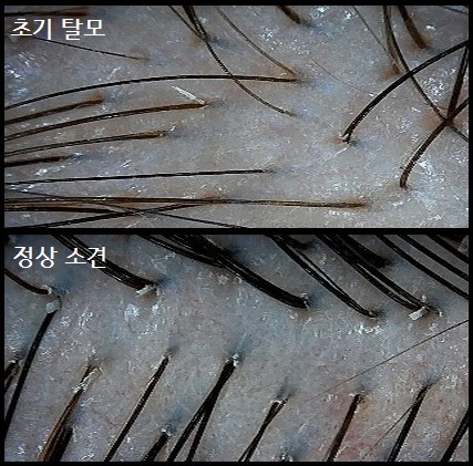 여성형 탈모는 무엇일까요? 관련 이미지 7