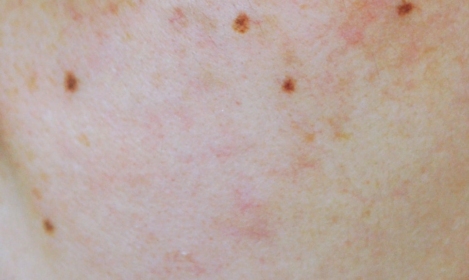 다양한 얼굴 색소 치료 #1 (점없애는법, 주근깨 없애는법) 관련 이미지 1