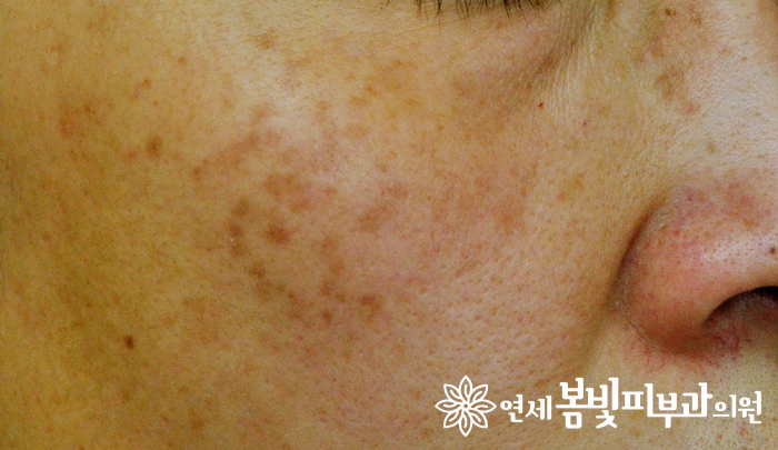 다양한 얼굴 색소 치료 #3 (오타모반, 오타모양반점) 관련 이미지 2