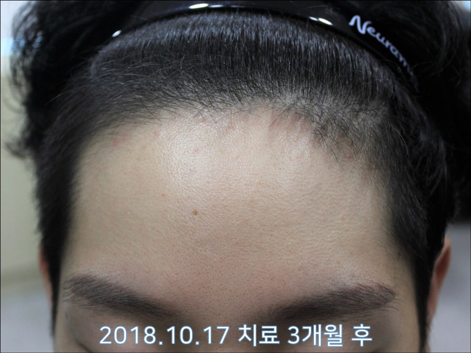 연세봄빛피부과 탈모치료 #26 (남성형탈모, 이마탈모) 관련 이미지 2