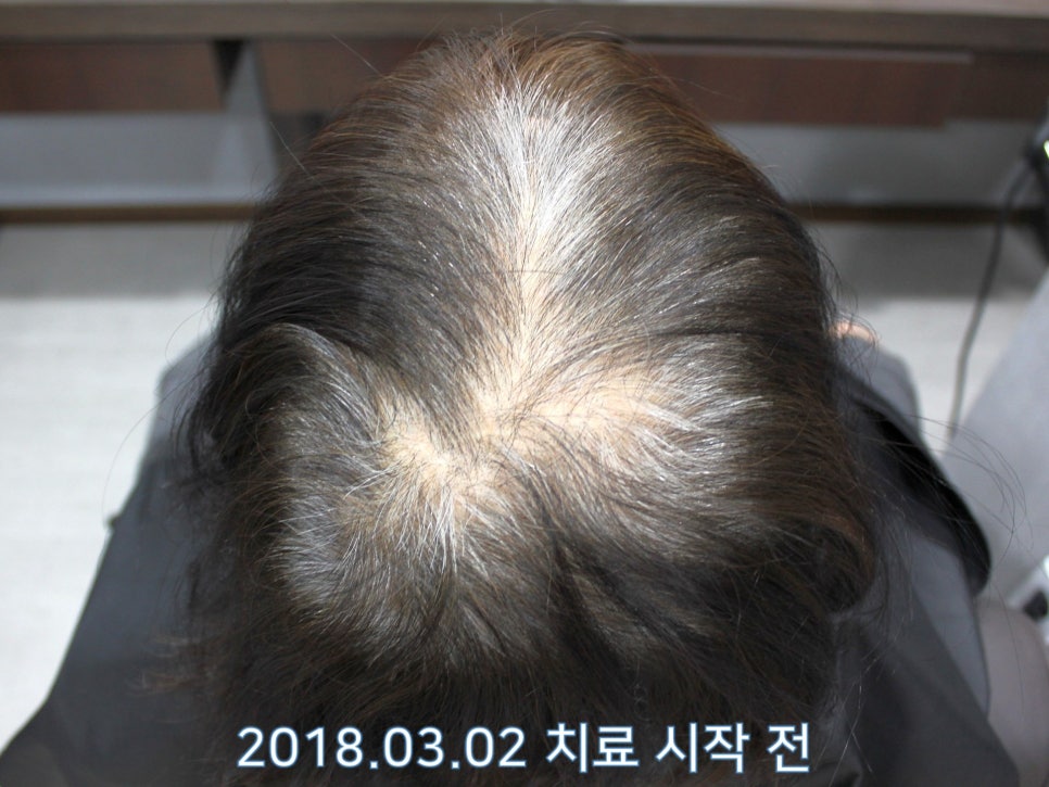 연세봄빛피부과 탈모치료 #19 (여성형탈모, 이마탈모, 정수리탈모, 부분가발) 관련 이미지 3