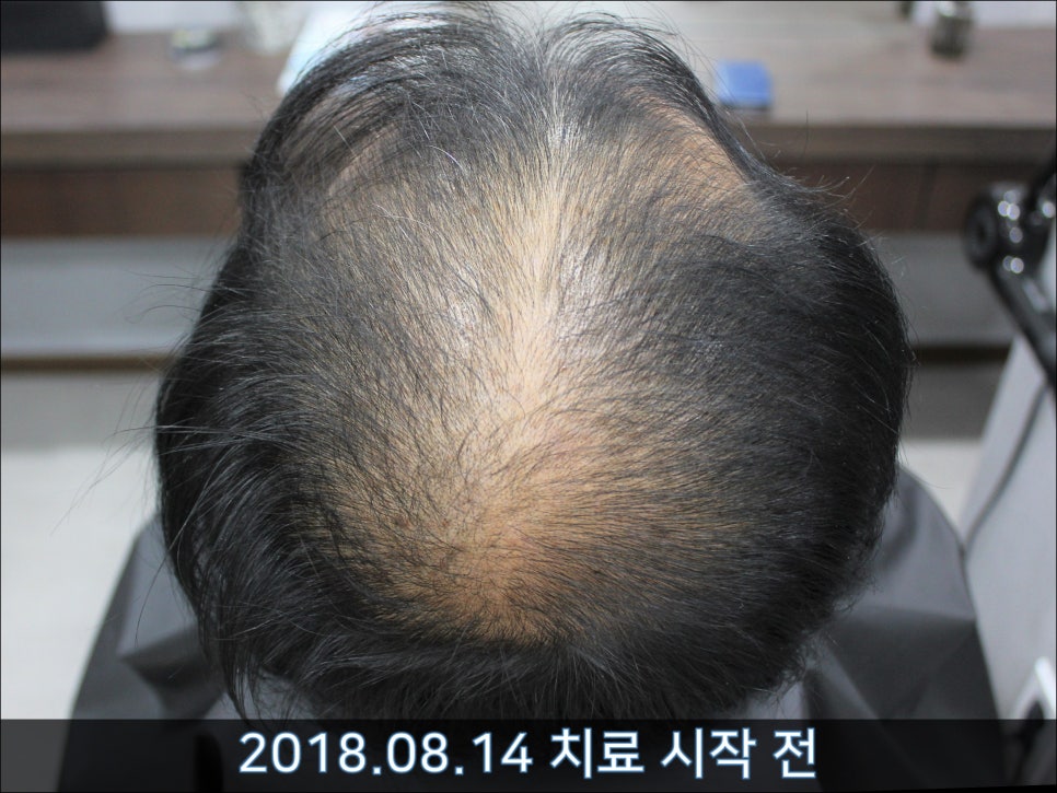 연세봄빛피부과 탈모치료 #39 (남성형탈모, 치료 중단 후 재치료) 관련 이미지 1