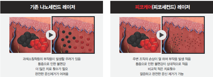 여름철에 기미치료 해도 될까요? 관련 이미지 3