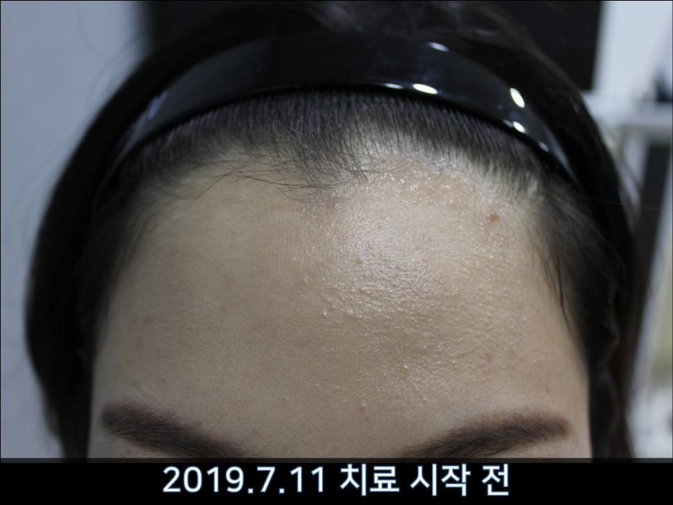 연세봄빛피부과 탈모치료 #38 (여성형탈모, 여성이마탈모) 관련 이미지 1