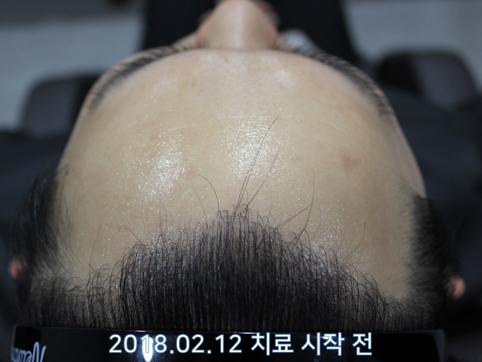연세봄빛피부과 탈모치료 #18 (남성형탈모, 이마탈모, 정수리탈모, 모발이식 후 치료) 관련 이미지 1