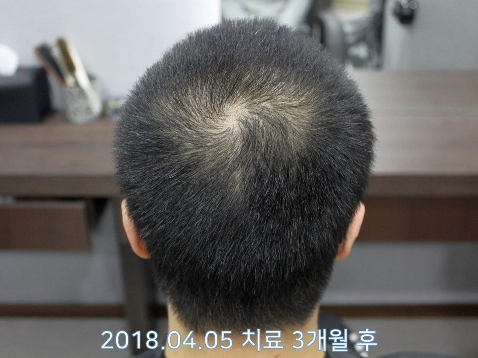 연세봄빛피부과 탈모치료 #17 (남성형탈모, 정수리탈모, F유형) 관련 이미지 6