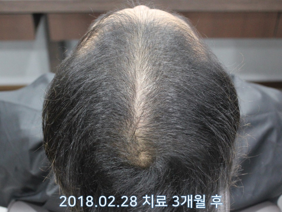 연세봄빛피부과 탈모치료 #11 (남성형탈모, 이마탈모, 정수리탈모) 관련 이미지 5