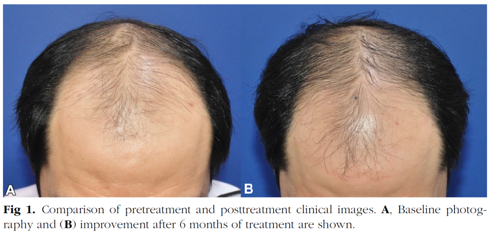 두피 보톡스 치료가 논문으로 발표되었습니다. (단국대학교 피부과 박병철 교수 연구팀) 관련 이미지 1