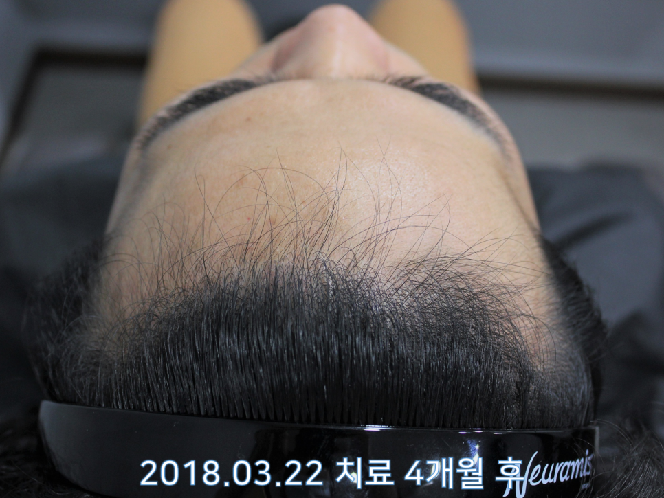 연세봄빛피부과 탈모치료 #13 (남성형탈모, 이마탈모) 관련 이미지 2