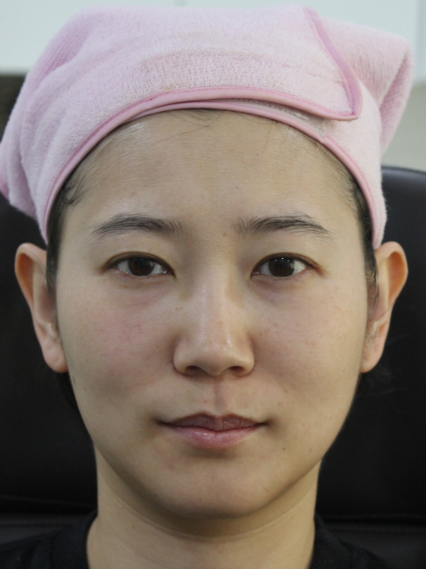 동안필러 치료 예시 #5 관련 이미지 1