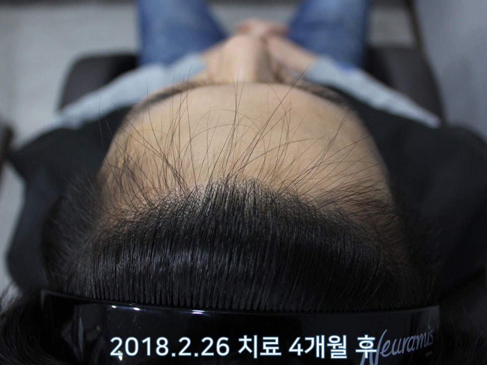 연세봄빛피부과 탈모치료 #12 (남성형탈모, 이마탈모, 정수리탈모) 관련 이미지 2