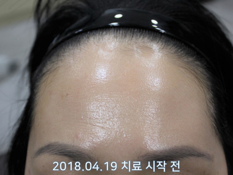 연세봄빛피부과 탈모치료 #21 (여성형탈모, 이마탈모) 관련 이미지 1