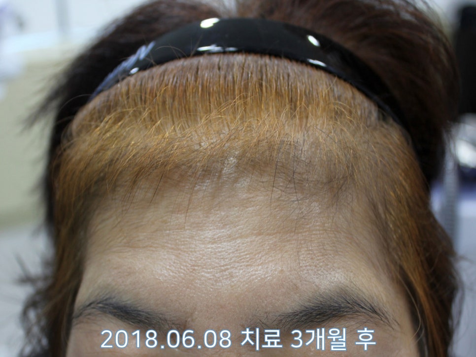 연세봄빛피부과 탈모치료 #19 (여성형탈모, 이마탈모, 정수리탈모, 부분가발) 관련 이미지 2