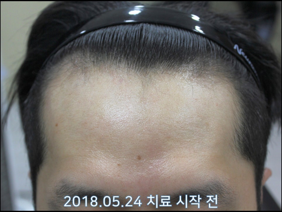 연세봄빛피부과 탈모치료 #22 (남성형탈모, 이마탈모) 관련 이미지 3