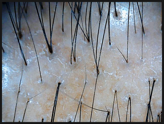 연세봄빛피부과 탈모치료 예시 (남성형탈모, 정수리탈모) 관련 이미지 7