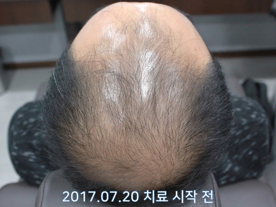 연세봄빛피부과 탈모치료 #9 (남성형탈모, 이마탈모, 정수리탈모) 관련 이미지 4