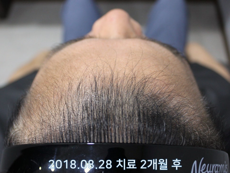 연세봄빛피부과 탈모치료 #16 (남성형탈모, 이마탈모, 정수리탈모, 3단계) 관련 이미지 8