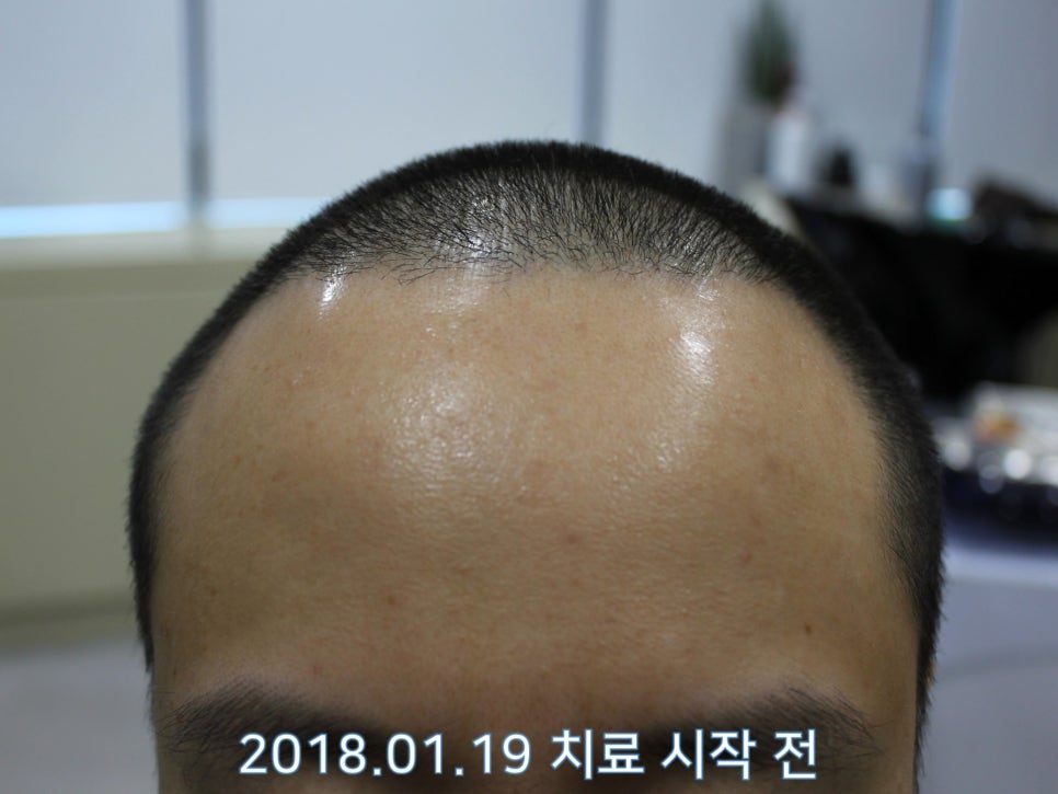 연세봄빛피부과 탈모치료 #17 (남성형탈모, 정수리탈모, F유형) 관련 이미지 2
