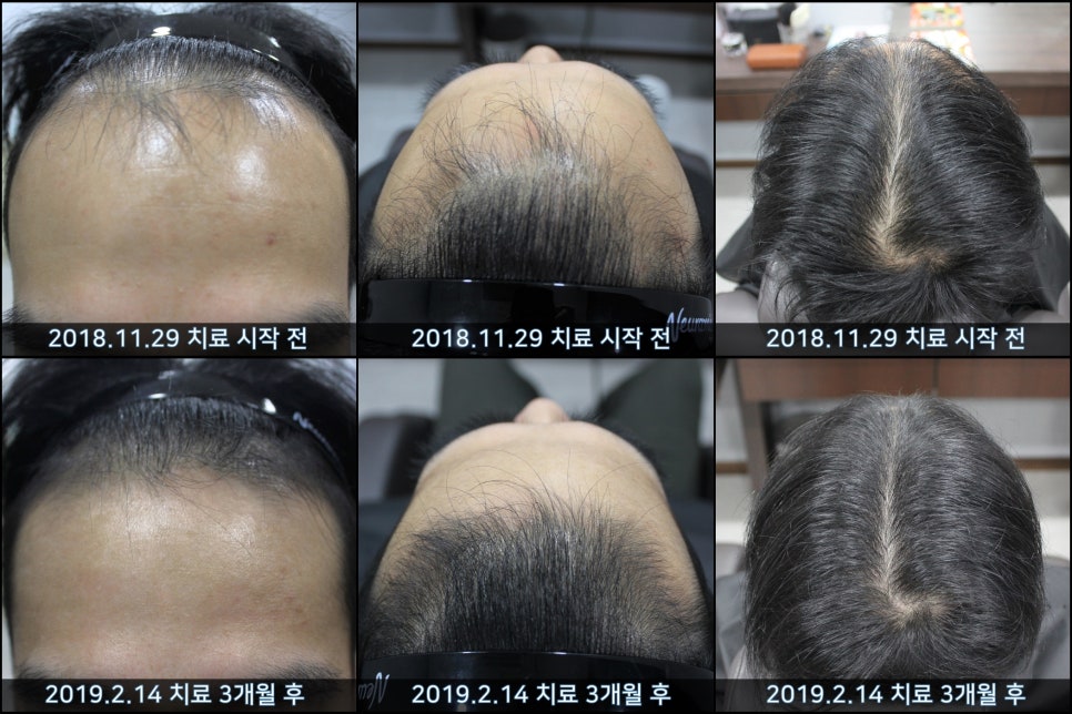 연세봄빛피부과 탈모치료 #35 (남성형탈모, 이마탈모, 가족력없음) 관련 이미지 7