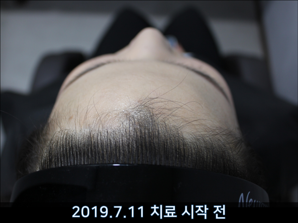 연세봄빛피부과 탈모치료 #38 (여성형탈모, 여성이마탈모) 관련 이미지 3