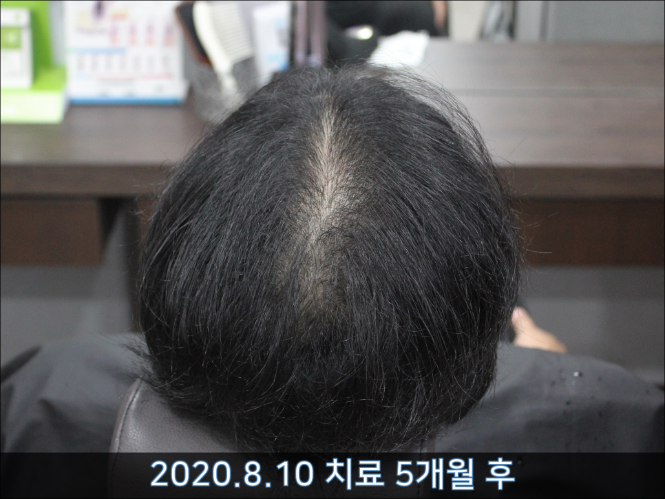 연세봄빛피부과 탈모치료 #44 (남성형탈모,M형+C형탈모) 관련 이미지 4