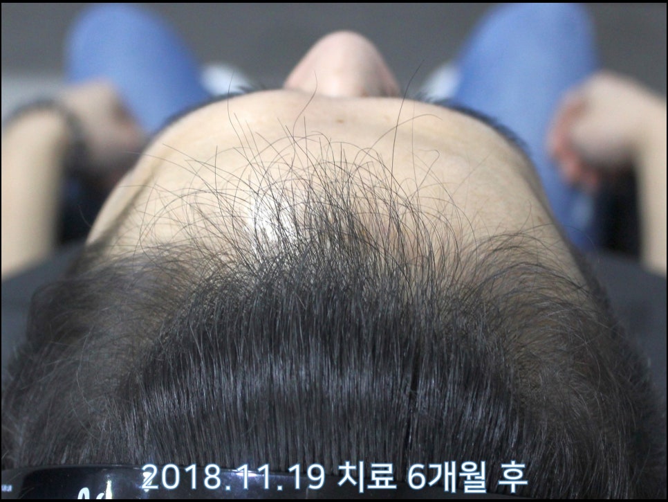 연세봄빛피부과 탈모치료 #22 (남성형탈모, 이마탈모) 관련 이미지 2