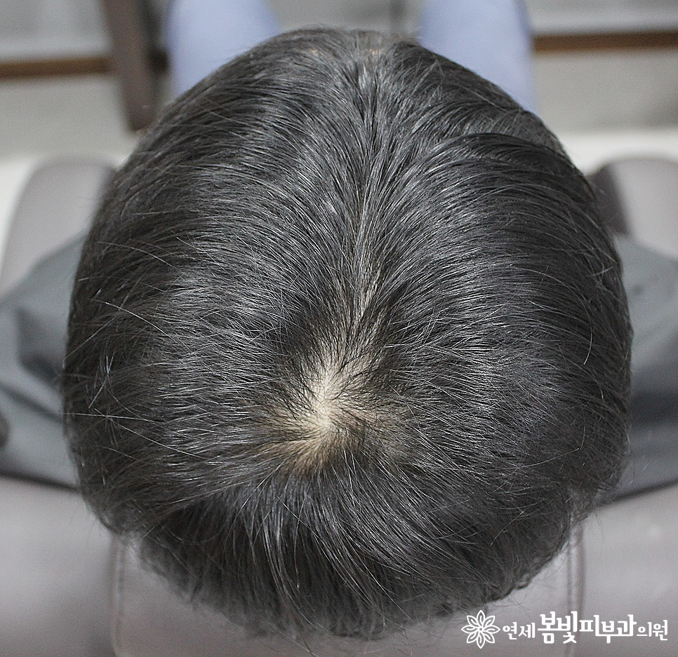 연세봄빛피부과 탈모치료 #2 (남성형탈모, 이마탈모, 정수리탈모) 관련 이미지 5