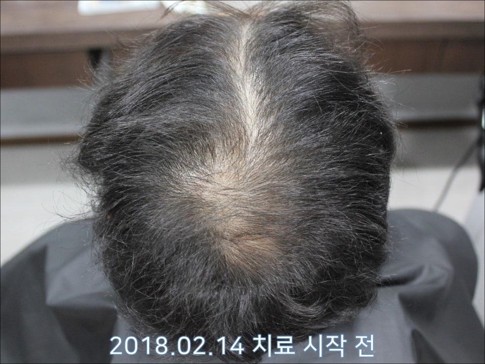연세봄빛피부과 탈모치료 #25 (남성형탈모, 재치료, 이마탈모, 정수리탈모) 관련 이미지 1