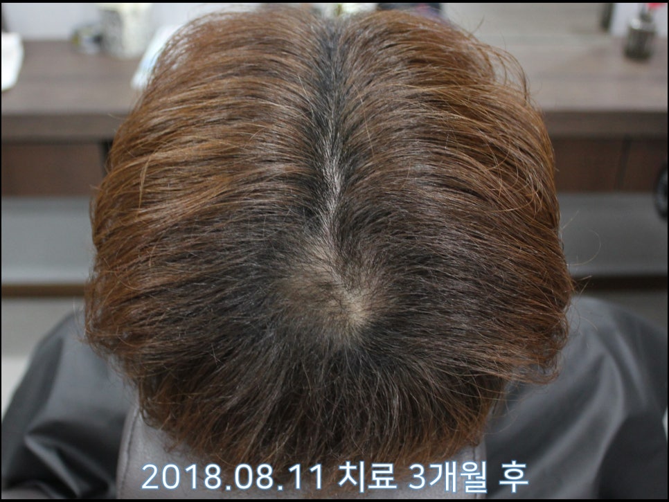 연세봄빛피부과 탈모치료 #23 (남성형탈모, 이마탈모, 정수리탈모) 관련 이미지 2