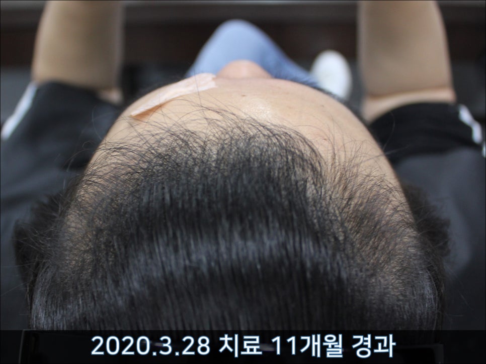 연세봄빛피부과 탈모치료 #42 (남성형탈모,M자탈모) 관련 이미지 5