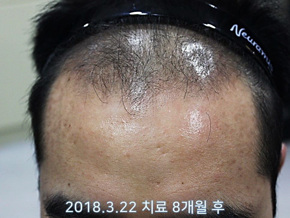 연세봄빛피부과 탈모치료 #9 (남성형탈모, 이마탈모, 정수리탈모) 관련 이미지 3