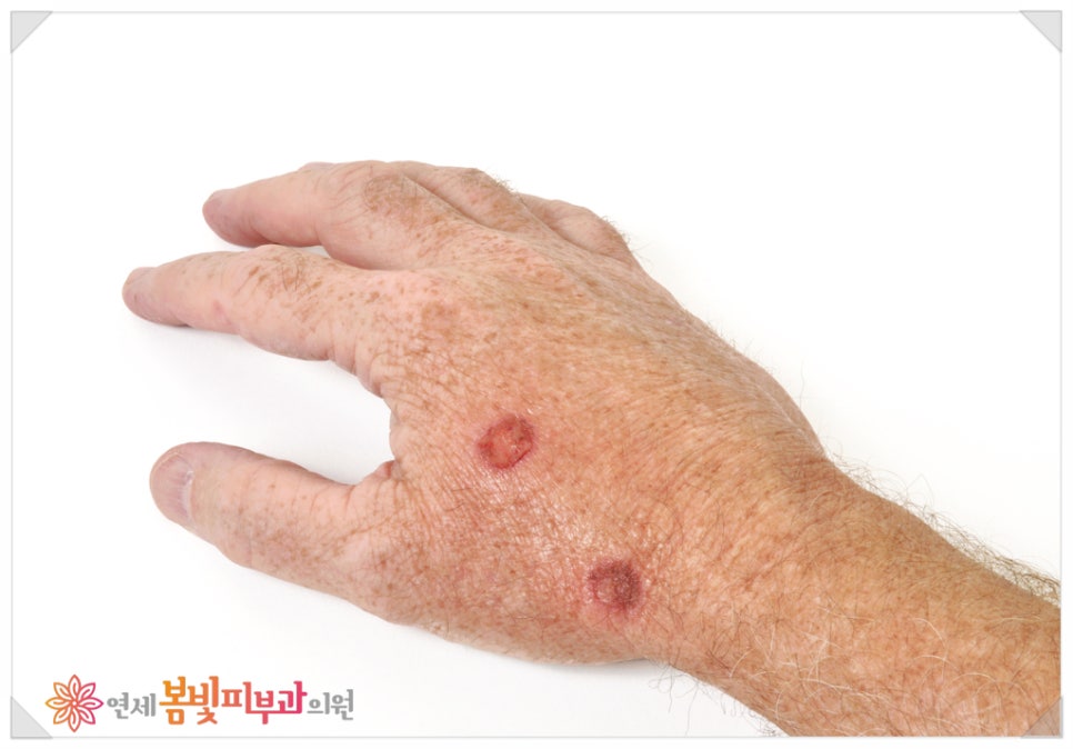 바이러스성 사마귀, 어떻게 치료 하나요? (사마귀 치료 방법, 냉동 치료, 블레오마이신 주사 치료,  레이저 치료, 면역 치료) 관련 이미지 2