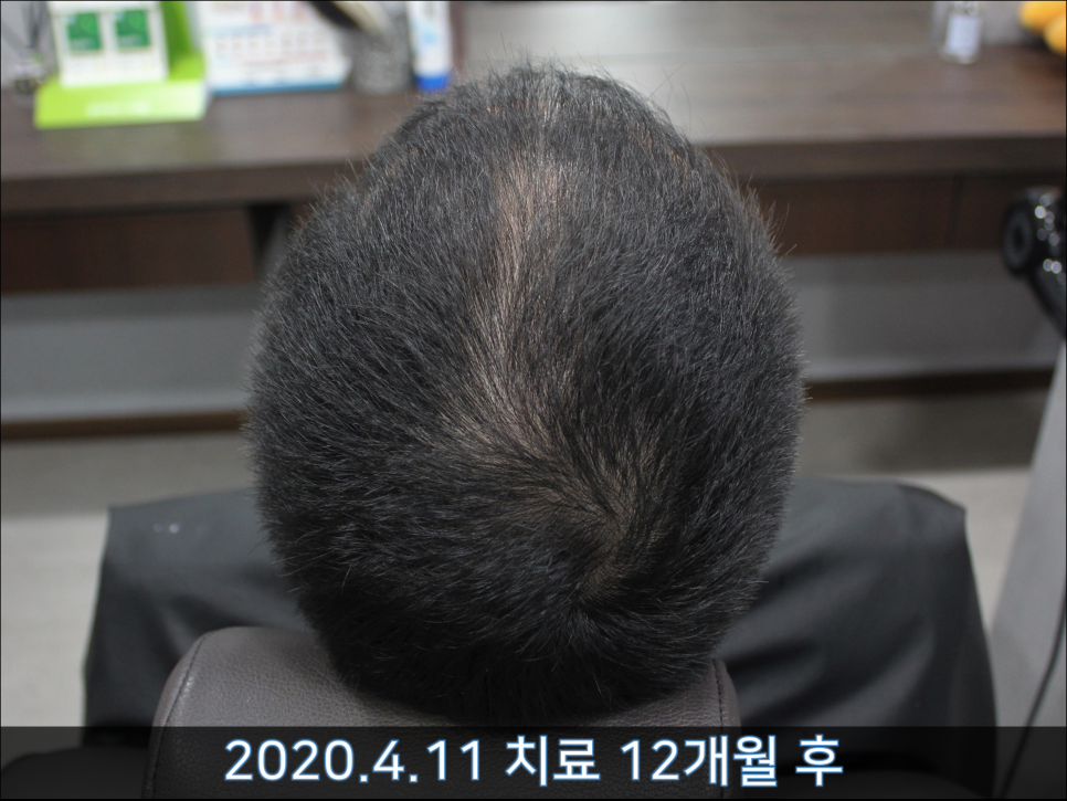 연세봄빛피부과 탈모치료 #41 (남성형탈모, 정수리탈모) 관련 이미지 4