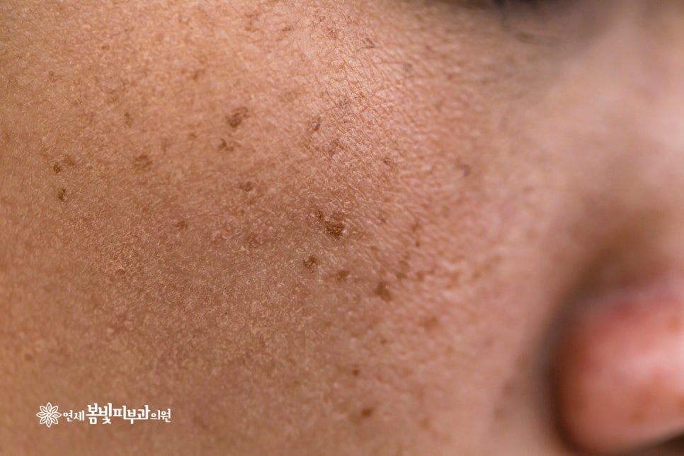 도란사민 캡슐 (기미) 효과 및 부작용 안내 관련 이미지 4