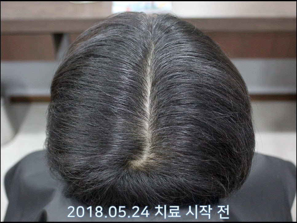 연세봄빛피부과 탈모치료 #22 (남성형탈모, 이마탈모) 관련 이미지 5